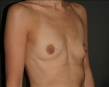 Breast Augmentation Before Photo by Otto Placik, MD, FACS; Arlington Heights, IL - Case 23633