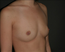 Breast Augmentation Before Photo by Otto Placik, MD, FACS; Arlington Heights, IL - Case 23635