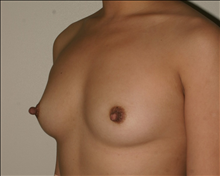 Breast Augmentation Before Photo by Otto Placik, MD, FACS; Arlington Heights, IL - Case 23640