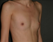 Breast Augmentation Before Photo by Otto Placik, MD, FACS; Arlington Heights, IL - Case 23644