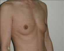 Breast Augmentation Before Photo by Otto Placik, MD, FACS; Arlington Heights, IL - Case 23647