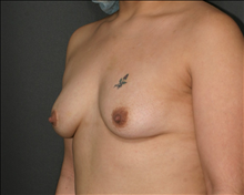 Breast Augmentation Before Photo by Otto Placik, MD, FACS; Arlington Heights, IL - Case 23651