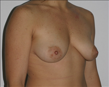 Breast Augmentation Before Photo by Otto Placik, MD, FACS; Arlington Heights, IL - Case 23653