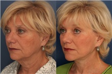 Facelift After Photo by Ronald Schuster, MD; Lutherville, MD - Case 32380