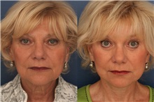 Facelift Before Photo by Ronald Schuster, MD; Lutherville, MD - Case 32380