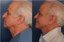 Facelift After Photo by Ronald Schuster, MD; Lutherville, MD - Case 32384