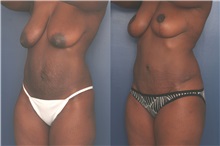 Tummy Tuck After Photo by Ronald Schuster, MD; Lutherville, MD - Case 32388