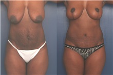 Tummy Tuck Before Photo by Ronald Schuster, MD; Lutherville, MD - Case 32388