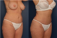 Tummy Tuck After Photo by Ronald Schuster, MD; Lutherville, MD - Case 32389