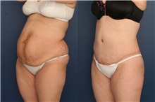 Tummy Tuck After Photo by Ronald Schuster, MD; Lutherville, MD - Case 32390