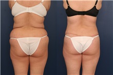 Tummy Tuck Before Photo by Ronald Schuster, MD; Lutherville, MD - Case 32390