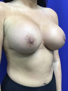 Breast Augmentation After Photo by Sutton Graham, II, MD; Greenville, SC - Case 39076