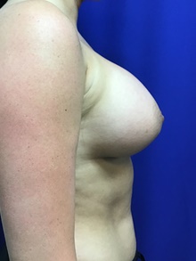 Breast Augmentation After Photo by Sutton Graham, II, MD; Greenville, SC - Case 39076