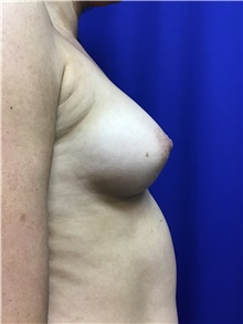Breast Augmentation Before Photo by Sutton Graham, II, MD; Greenville, SC - Case 39076