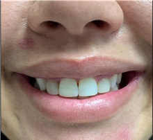 Lip Augmentation/Enhancement After Photo by Sutton Graham, II, MD; Greenville, SC - Case 40783