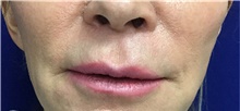 Lip Augmentation / Enhancement After Photo by Sutton Graham, II, MD; Greenville, SC - Case 40784