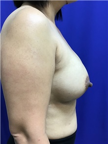 Breast Augmentation After Photo by Sutton Graham, II, MD; Greenville, SC - Case 40785