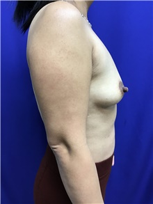 Breast Augmentation Before Photo by Sutton Graham, II, MD; Greenville, SC - Case 40785