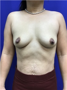 Breast Augmentation Before Photo by Sutton Graham, II, MD; Greenville, SC - Case 40785