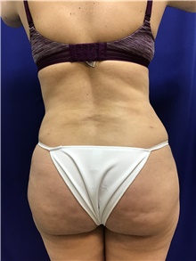 Buttock Lift with Augmentation After Photo by Sutton Graham, II, MD; Greenville, SC - Case 40786
