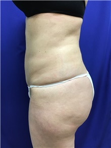 Buttock Lift with Augmentation After Photo by Sutton Graham, II, MD; Greenville, SC - Case 40786