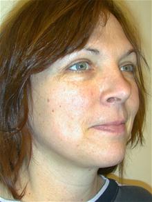 Liposuction After Photo by Eric Marchant, MD; Doylestown, PA - Case 28250