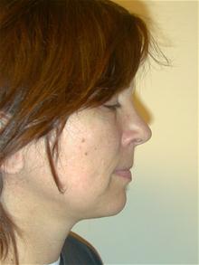 Liposuction After Photo by Eric Marchant, MD; Doylestown, PA - Case 28250