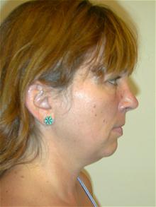 Liposuction Before Photo by Eric Marchant, MD; Doylestown, PA - Case 28250
