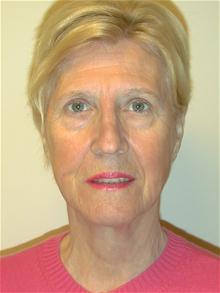 Facelift After Photo by Eric Marchant, MD; Doylestown, PA - Case 28255