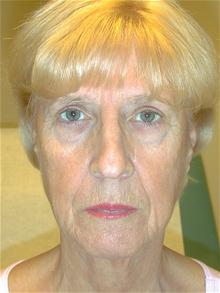 Facelift Before Photo by Eric Marchant, MD; Doylestown, PA - Case 28255