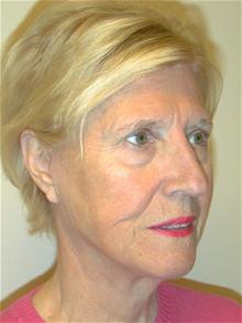 Facelift After Photo by Eric Marchant, MD; Doylestown, PA - Case 28255