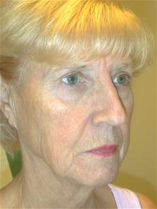 Facelift Before Photo by Eric Marchant, MD; Doylestown, PA - Case 28255