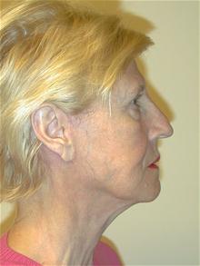 Facelift After Photo by Eric Marchant, MD; Doylestown, PA - Case 28255