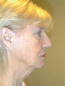 Facelift Before Photo by Eric Marchant, MD; Doylestown, PA - Case 28255