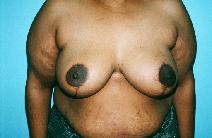 Breast Reduction After Photo by Dennis Schuster, MD, DDS; Fort Worth, TX - Case 6637
