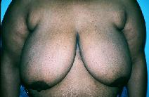 Breast Reduction Before Photo by Dennis Schuster, MD, DDS; Fort Worth, TX - Case 6637