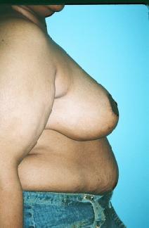 Breast Reduction After Photo by Dennis Schuster, MD, DDS; Fort Worth, TX - Case 6637