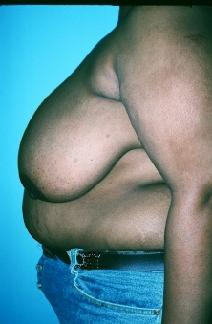 Breast Reduction Before Photo by Dennis Schuster, MD, DDS; Fort Worth, TX - Case 6637