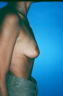Breast Augmentation Before Photo by Dennis Schuster, MD, DDS; Fort Worth, TX - Case 6640