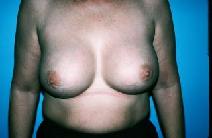 Breast Augmentation After Photo by Dennis Schuster, MD, DDS; ,  - Case 6641