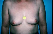 Breast Augmentation Before Photo by Dennis Schuster, MD, DDS; ,  - Case 6641