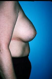 Breast Augmentation After Photo by Dennis Schuster, MD, DDS; ,  - Case 6641