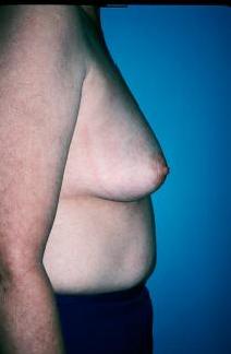 Breast Augmentation Before Photo by Dennis Schuster, MD, DDS; ,  - Case 6641