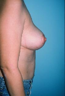 Breast Reduction After Photo by Dennis Schuster, MD, DDS; Fort Worth, TX - Case 6642