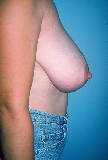 Breast Reduction Before Photo by Dennis Schuster, MD, DDS; Fort Worth, TX - Case 6642