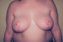 Breast Reduction After Photo by Dennis Schuster, MD, DDS; Fort Worth, TX - Case 6643