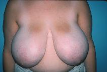 Breast Reduction Before Photo by Dennis Schuster, MD, DDS; Fort Worth, TX - Case 6643