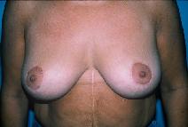 Breast Reduction After Photo by Dennis Schuster, MD, DDS; Fort Worth, TX - Case 6644