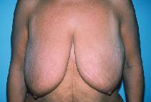 Breast Reduction Before Photo by Dennis Schuster, MD, DDS; Fort Worth, TX - Case 6644