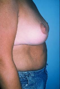 Breast Reduction After Photo by Dennis Schuster, MD, DDS; Fort Worth, TX - Case 6644